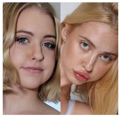 chloe cherry before fillers|chloe cherry lip fillers.